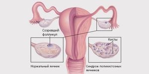 Bolile ovariene polichistice primare și secundare cauzează simptome și tratament