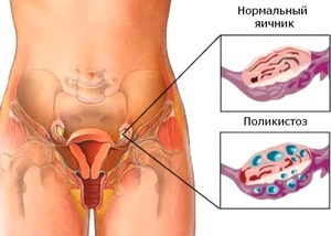 Первинний і вторинний полікістоз яєчників причини захворювання, симптоми і лікування