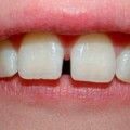 De ce dinții devin negri, ce trebuie să fac dacă dintele din față sa întunecat din interior