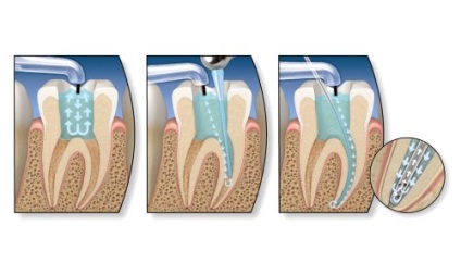 După umplerea canalelor, dintele doare atunci când este presată, durere pulsantă