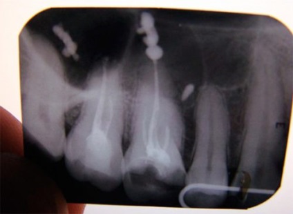 După umplerea canalelor, dintele doare atunci când este presată, durere pulsantă