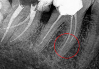 După umplerea canalelor, dintele doare atunci când este presată, durere pulsantă