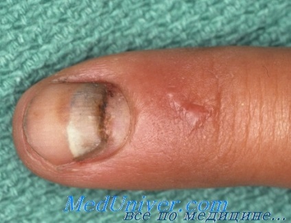 Deteriorarea vârfului degetului și a unghiei