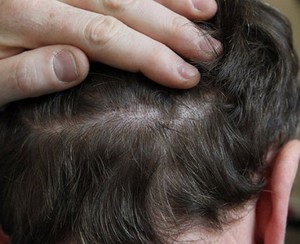 Cauzele și tratamentul acneei asupra capului în păr la bărbați simptome și tratament, metode de luptă