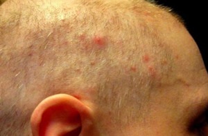 Cauzele și tratamentul acneei asupra capului în păr la bărbați simptome și tratament, metode de luptă