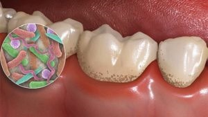 Az okok a fogszuvasodás