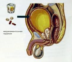 Prostatita, publicitate sub formă de pilule din prostatită, semne de prostatită a bolii, antibiotice utilizate