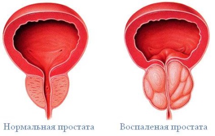 Prostatita, publicitate sub formă de pilule din prostatită, semne de prostatită a bolii, antibiotice utilizate