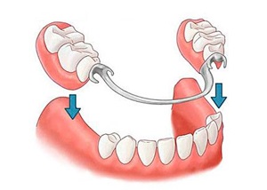 Elementele protetice ale stomatologiei și avantajele metodei dentare