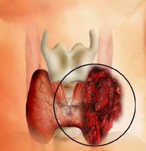 Рак щитовидної залози