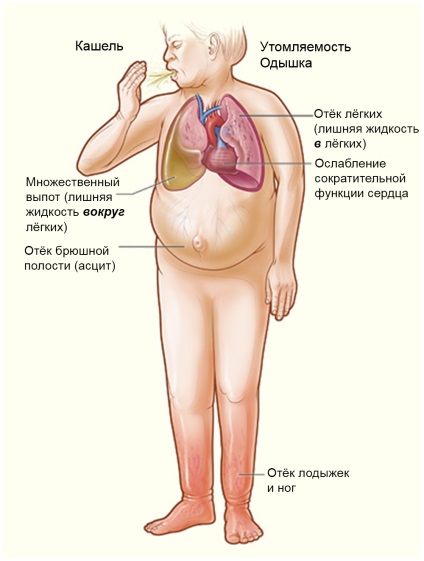 Dispneea cardiacă - cauze, diagnostic, tratament