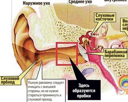 Сірчана пробка у вусі