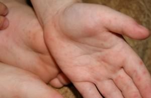 Erupțiile din palmele adulților și copiilor provoacă, simptome și tratament