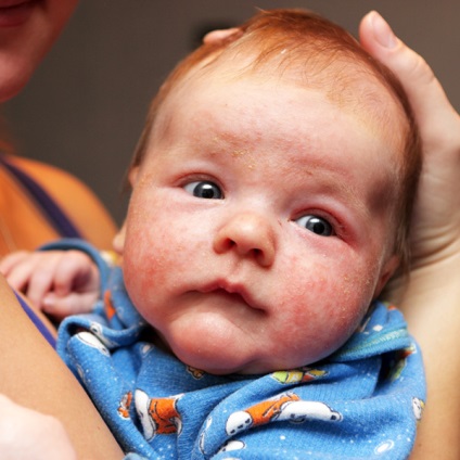 A kiütés a újszülött lehetséges okok és a kezelés