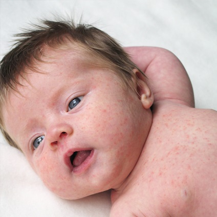 A kiütés a újszülött lehetséges okok és a kezelés