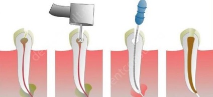 Cât costă tratamentul canalelor cu parodontită, fotografii și recenzii ale dentistului
