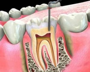 Скільки в зубі каналів