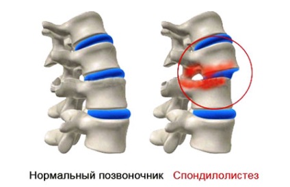 Deplasarea vertebrelor din regiunea lombară, simptome