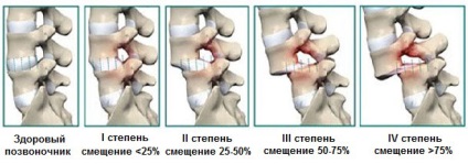 Deplasarea vertebrelor din regiunea lombară, simptome