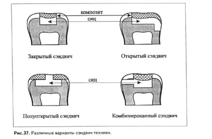 Сучасні аспекти сендвіч-технік, стомленд