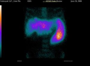 Scintigrafia întregului corp al rinichilor, ficatului, plămânilor, glandelor mamare, prețului la Moscova și contraindicațiilor