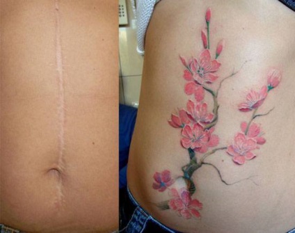 Tatuaj pe cicatrici - tatuaje care ascund cicatrici