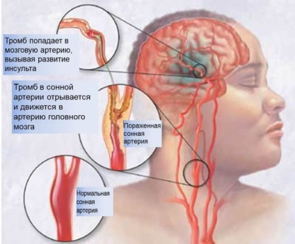 Simptomele trombozei sinusurilor sinusoidale, cauzele și metodele de tratament