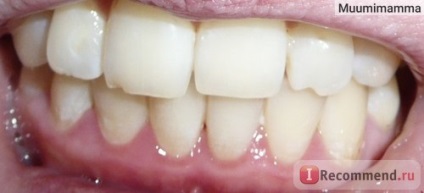 Видалення зубного каменю - «процедура видалення зубного каменю не дуже-то приємна, але користь її для