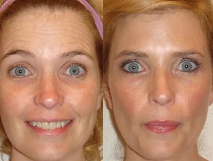 Injectiile cu Botox - ultimul secol!