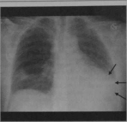 Contuzii cardiace