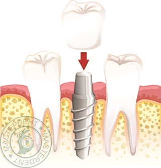 Instalarea de implanturi în clinica stomatologică