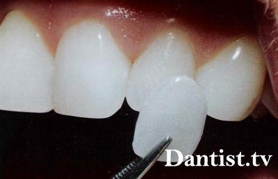 Види протезування зубів ціна і фото
