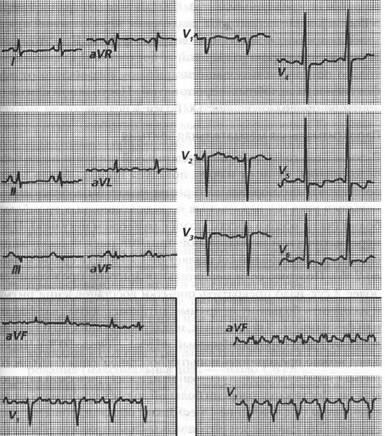 Vindecarea fibrilației atriale - tratament cardiac