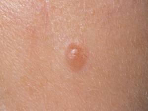 Intracermulus nevus (melanocit intradermic)