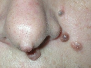 Intracermulus nevus (melanocit intradermic)