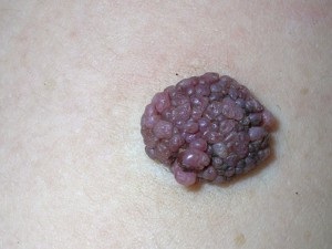 Intracermulus nevus (melanocit intradermic)