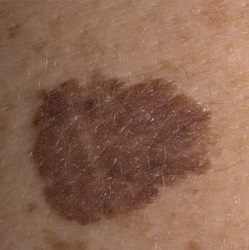 Внутрідермальний невус шкіри причини, особливості та методи лікування