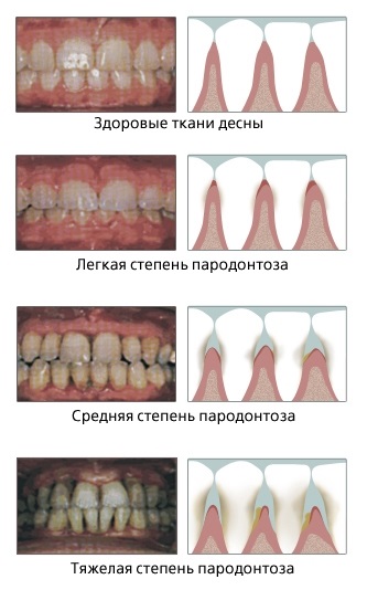 Tratamentul și prevenirea bolilor parodontale