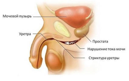 Стагнация на кръв в органите на малкия таз при жените и мъжете