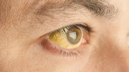 Sárga fehérjék szem okok és a kezelés, LS