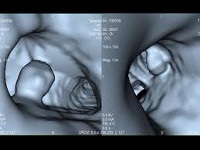 Adenomul bronșic - cauze, simptome, diagnostic și tratament