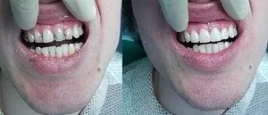 Refacerea adezivă și metodele de tratament dentar