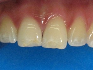 Refacerea adezivă și metodele de tratament dentar