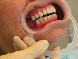 Refacerea dintelui adeziv