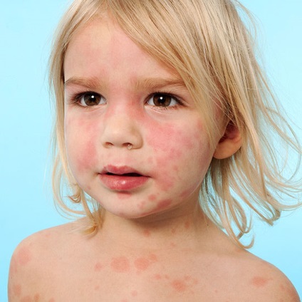 Alergia cauzelor, simptomelor și tratamentului de curmale