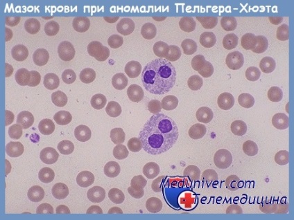 Anomalia pelger-huet (pelger-huet) - cauze, clinica