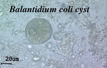 Balantidiasis (Balantidium coli, bél Balantidium) emberben a tünetek, diagnózis, kezelés,