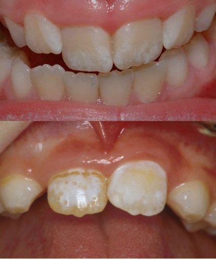 Білі плями на зубах у дитини причини появи і лікування