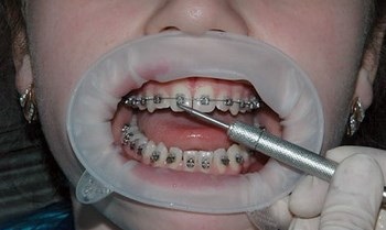 Брекети - стоматологія Денталюкс г