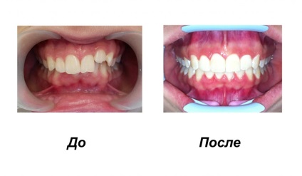 Bretele - stomatologie d. Stomatologie g